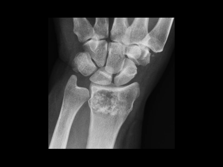 Figure 1 for case enchondroma ( RID4128 )